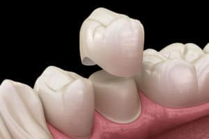Dental Crown - Hamamoto Dentistry - Bothell WA Dentist