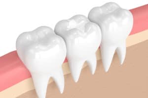 Dental Fillings - Hamamoto Dentistry - Bothell WA Dentist