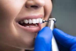 Dental Cleaning - Hamamoto Dentistry - Bothell Dentist