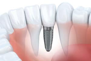 Dental Implants - Hamamoto Dentistry - Bothell Dentist